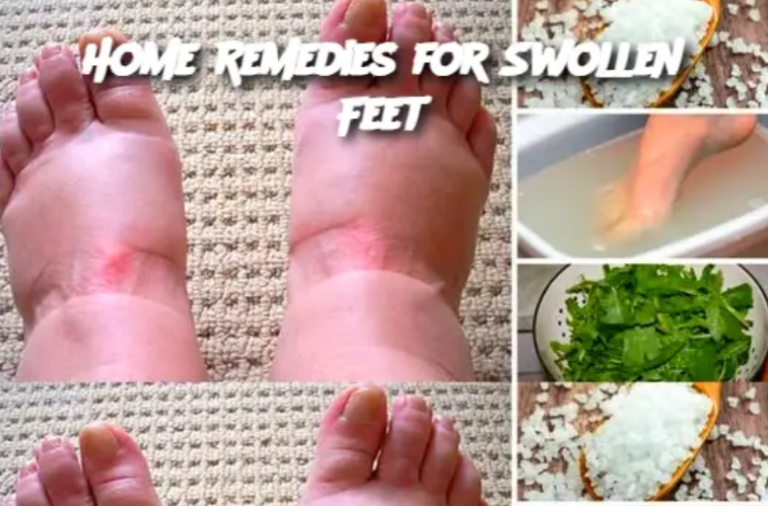 Home Remedies for Swollen Feet