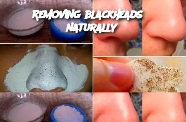 Removing blackheads naturally