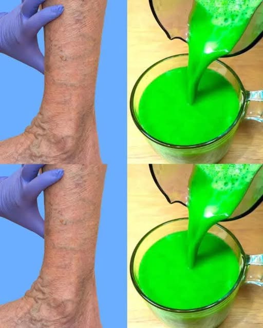 One Cup to Soothe Varicose Veins—No More Heavy Legs!