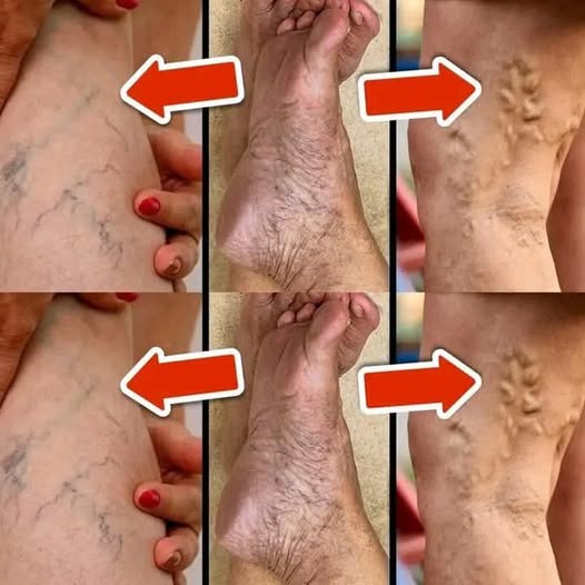 8 Natural Ways to Get Rid of Varicose Veins and Boost Blood Circulation