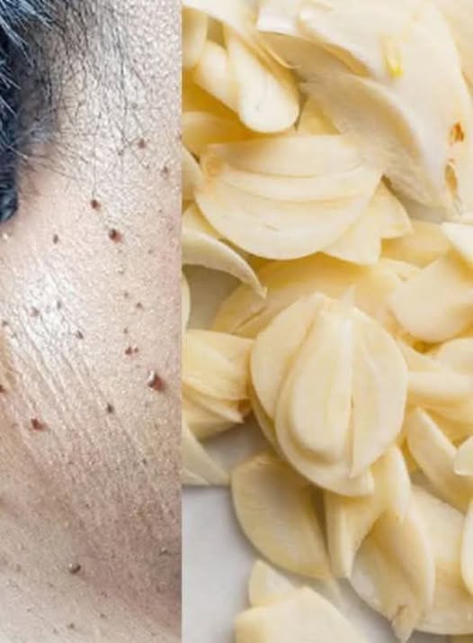 Remove Skin Tags Naturally with Garlic – Fast & Effective Remedy!