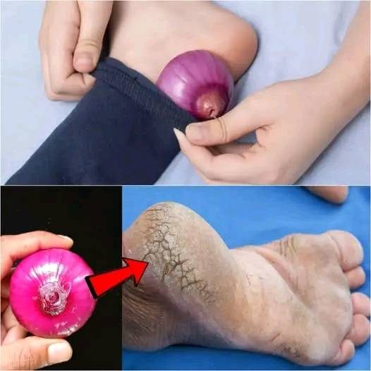 Remove Cracked Heels and Get Beautiful Feet Permanently – The Magical Onion Remedy