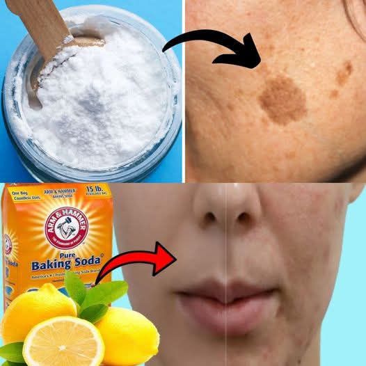 BAKING SODA REMOVES AGE SPOTS, ACNE, BLACKHEADS! This is what you need to do...